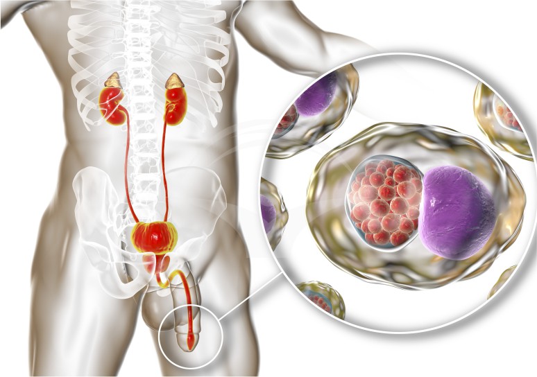 Infecțiile urinare la bărbați: simptome, diagnostic și tratament - Smart Medical