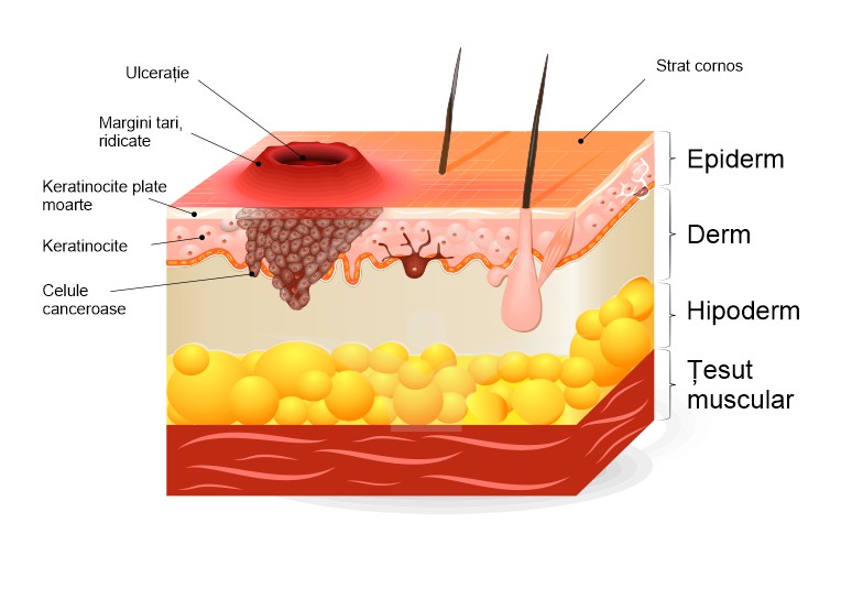 Carcinomul cu celule scuamoase: cauze, simptome, tratament