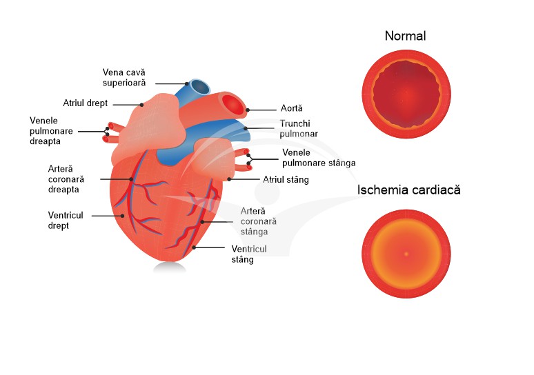 Ischemia cardiaca: cauze, simptome si tratament