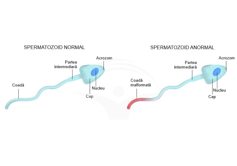 Infertilitatea masculina: cauze, simptome, tratament