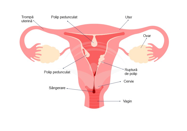 Metroragia: cauze, simptome si tratament