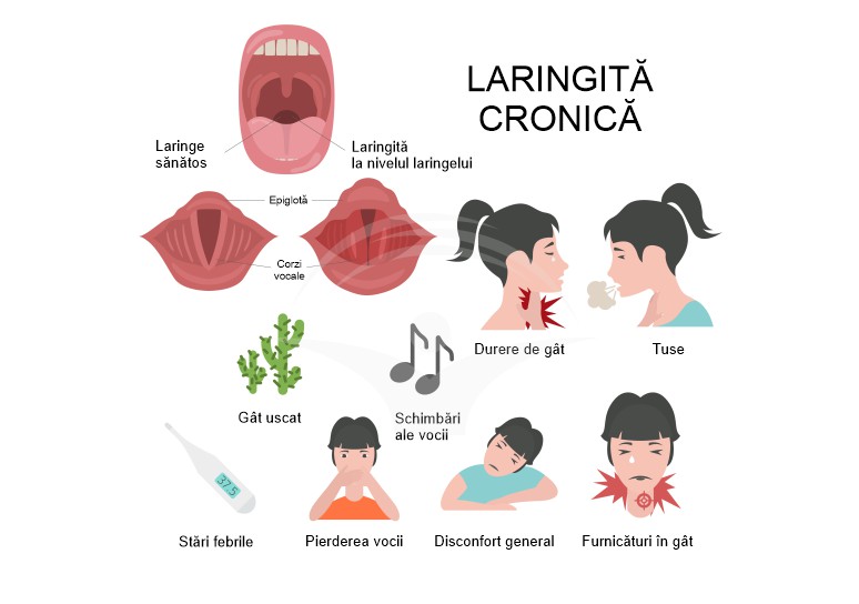 Laringita cronica: cauze, simptome si tratament