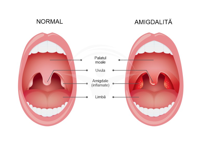 Amigdalita: cauze, simptome si tratament