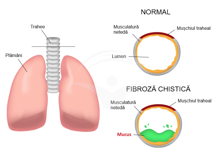 Fibroza chistica: etiologie, simptome si terapie