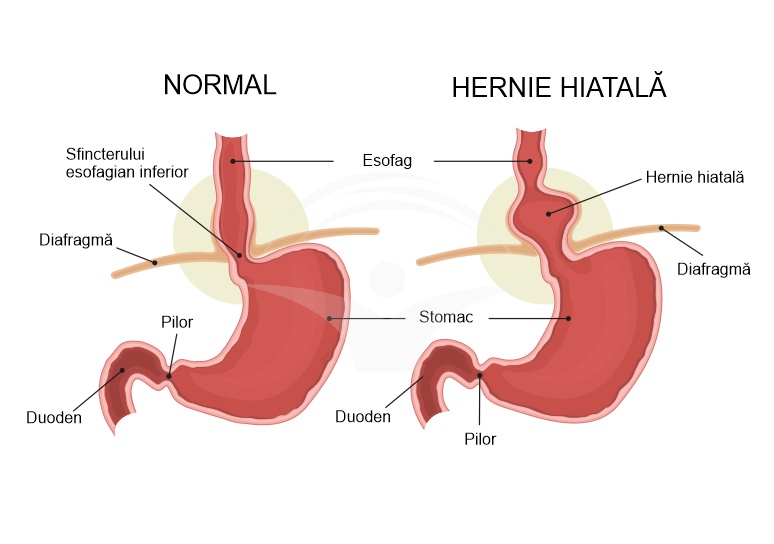 Hernia hiatala: etiologie, manifestari clinice si tratament
