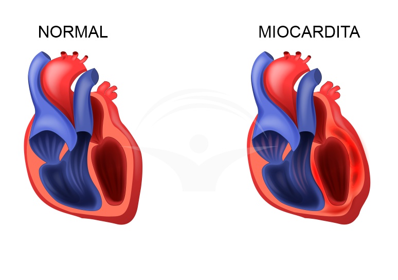 Miocardita: etiologie, simptome si investigatii