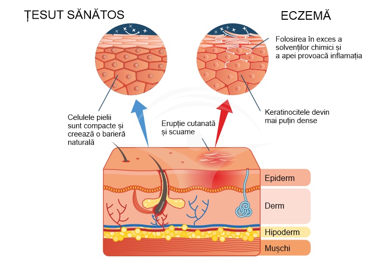 Eczema: forme clinice, cauze si tratament