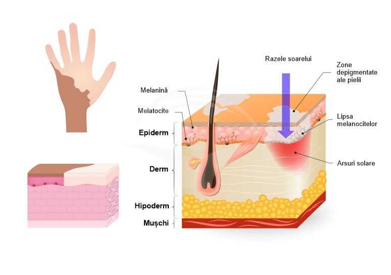 Vitiligo: forme clinice si tratament