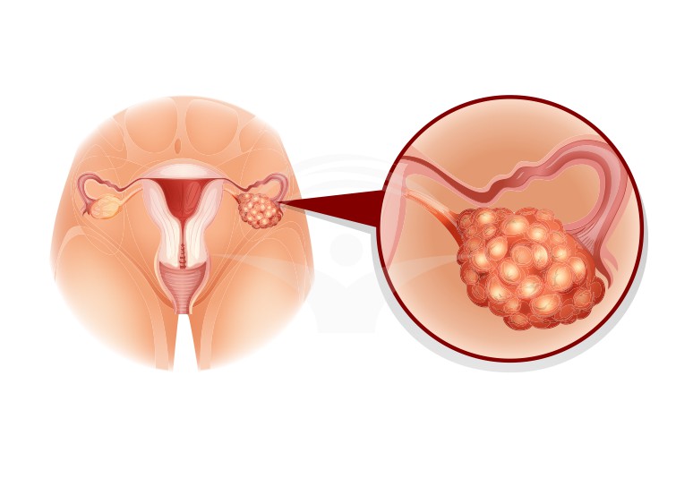 Tumori ovariene: forme clinice, investigatii, tratament