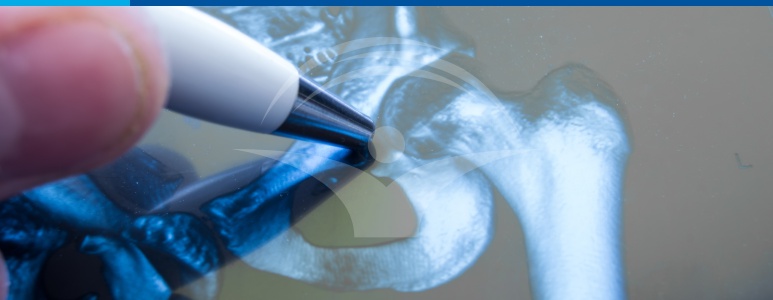 Proteza de sold - artroplastia totala de sold