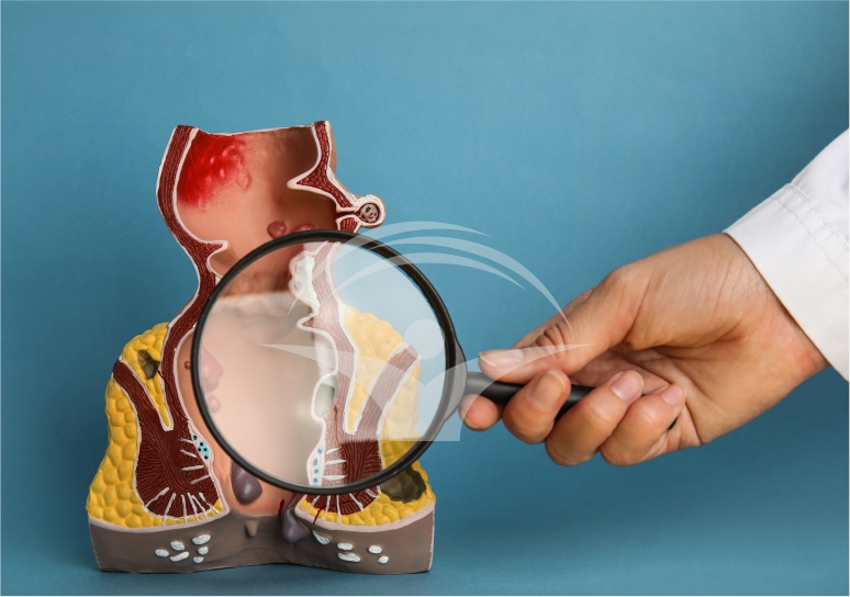 Operatia de hemoroizi cu stapler