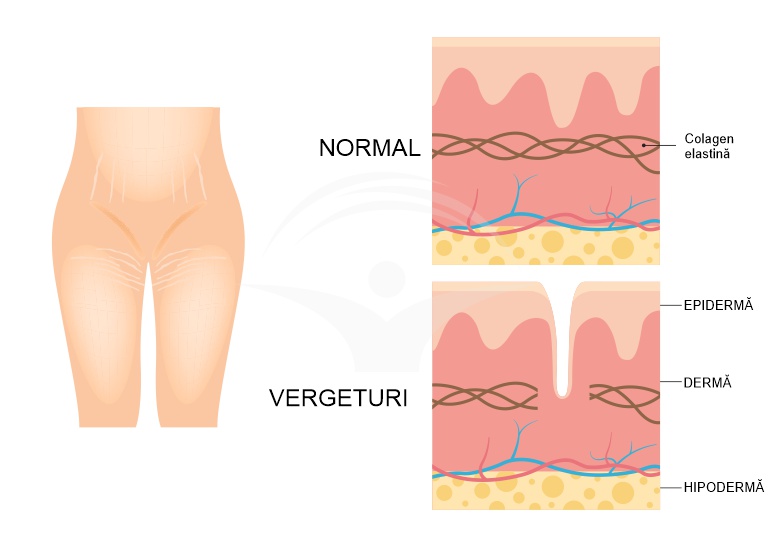 Vergeturile: de ce apar si cum le tratam