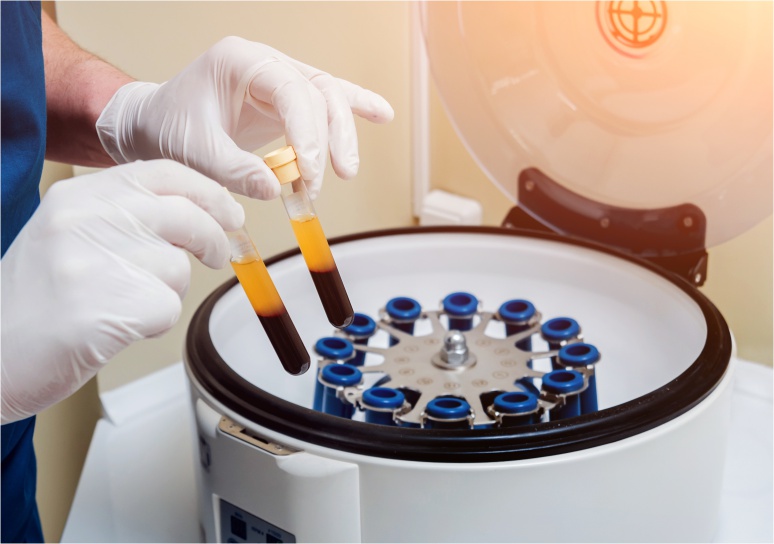 Ce sunt infiltratiile cu plasma imbogatita cu trombocite?