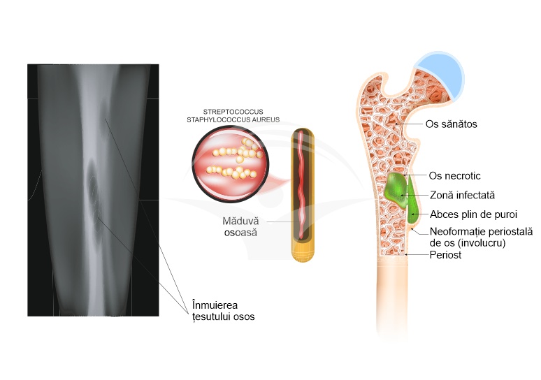 Osteomielita: cauze, simptome si tratament