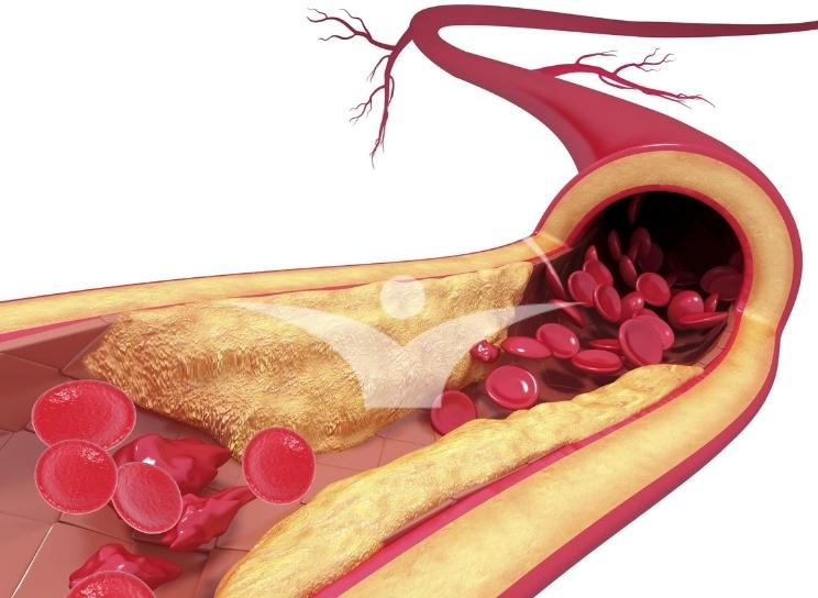 Ateroscleroza - Depuneri de lipide in peretii vaselor de sange