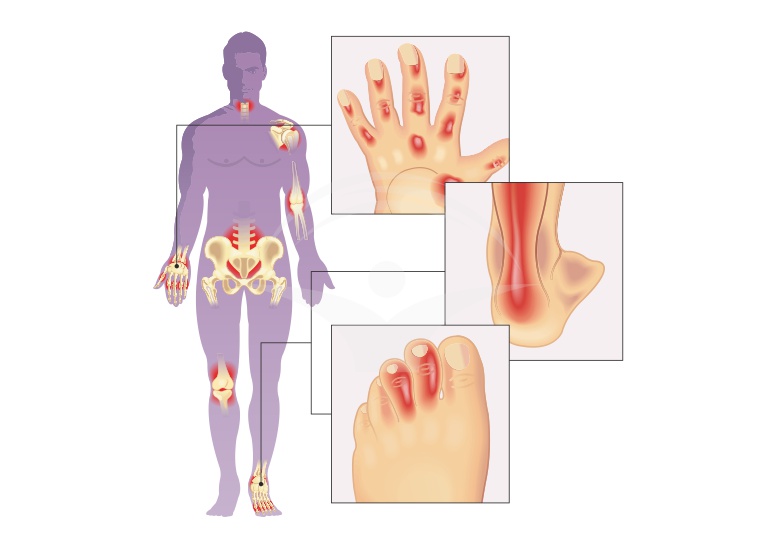 Artrita psoriazica: cauze, simptome si tratament