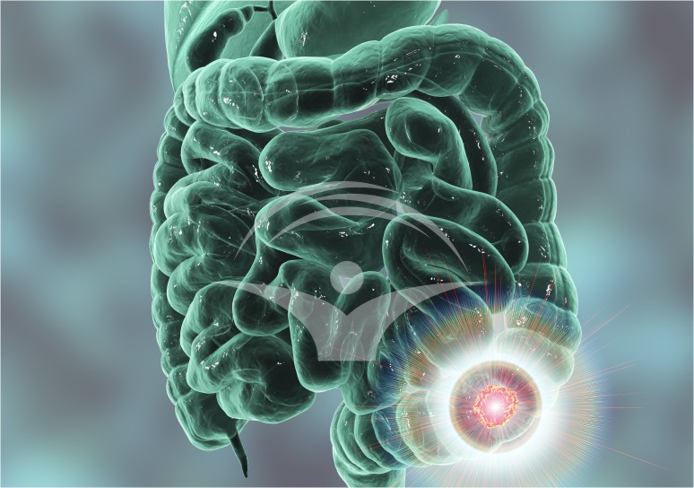 Care sunt simptomele cancerului de colon?
