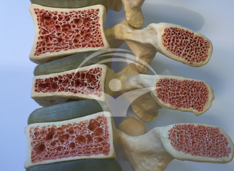 Diferite stadii ale osteoporozei