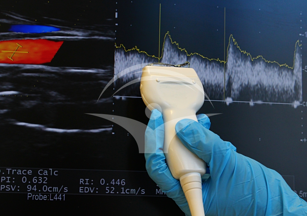 Ecografia Doppler