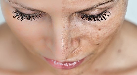 peeling chimic pentru tratament anti-îmbătrânire a pielii)