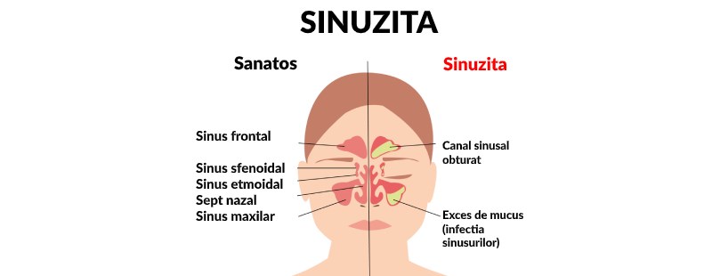 simptomele paraziților din sinusuri