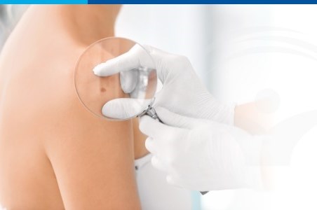 Melanom: forme clinice, manifestari si tratament