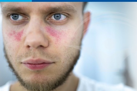 Lupusul eritematos sistemic - “boala cu o&nbsp;mie de fete”