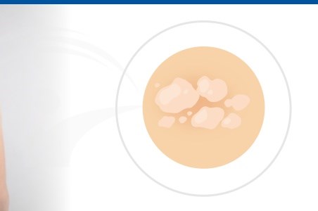 Pitiriazis - cauze, manifestari si tratament