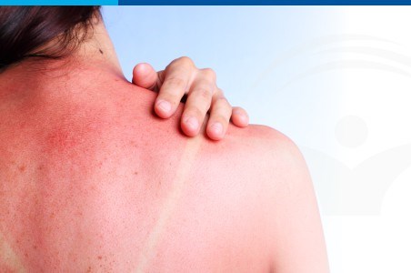 Ce trebuie sa stiu despre arsurile solare