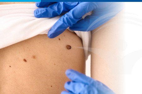 Carcinomul cu celule scuamoase: cauze, simptome, tratament