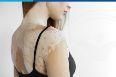 Vitiligo: forme clinice si tratament