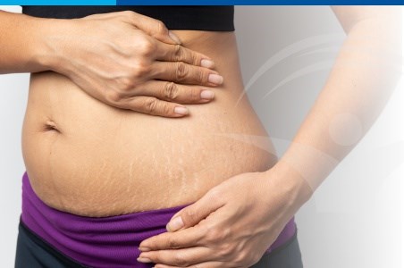 Vergeturile: de ce apar si cum le tratam