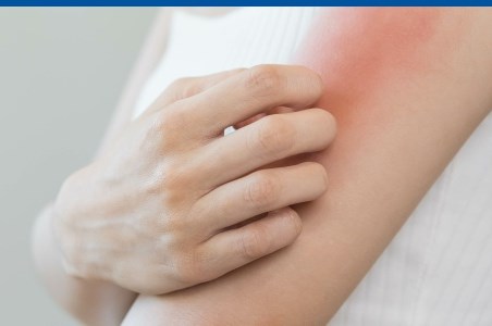 Muscatura de paianjen si intepaturile de insecte