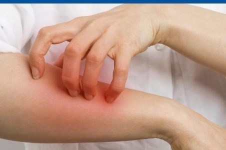 Afectiuni dermatologice care se agraveaza primavara