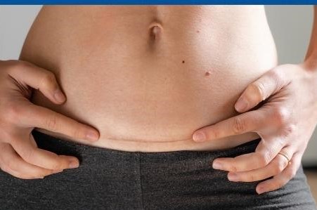 Recuperarea dupa cezariana