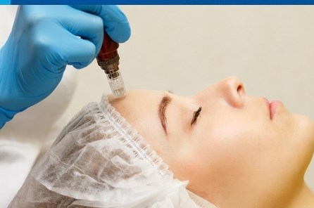 Mezoterapie – frumusete si sanatate fara bisturiu