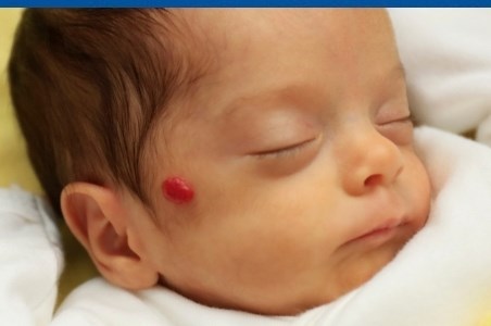 Hemangiom la bebelusi – din ce cauze apare si cum poate fi tratat