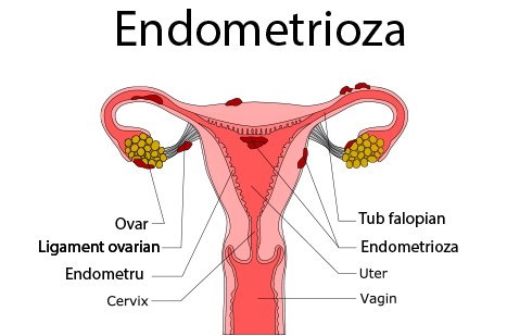 Totul despre Endometrioza – ce este, care sunt simptomele si cum se trateaza