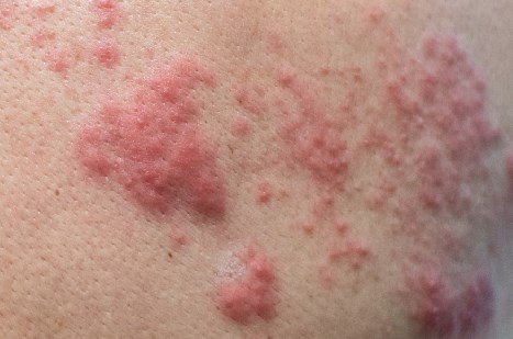 Zona Zoster – simptome 