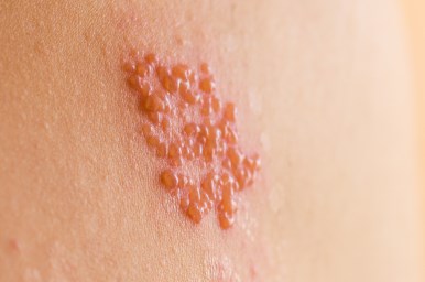 Zona Zoster – simptome, manifestari, tratament