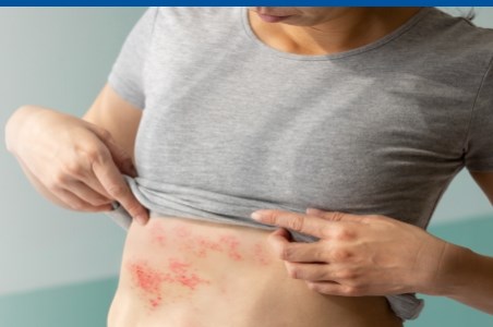 Zona zoster: cauze, simptome si tratament