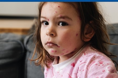 Rujeola: simptome, evolutie si metode de preventie