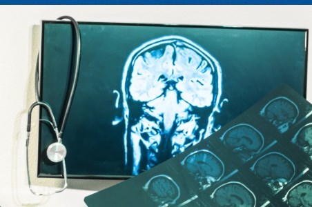 Anevrism cerebral: simptome si tratament