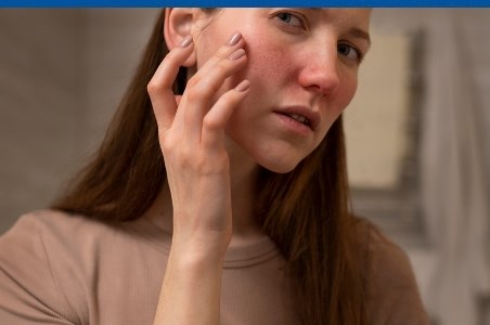 Cuperoza - ce anume declanseaza aceasta afectiune a&nbsp;pielii?