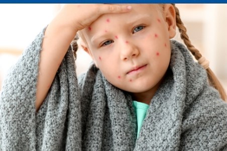 Varicela - ce trebuie sa stim despre varsatul de vant