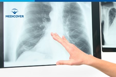 Embolie pulmonara (tromboembolism): cauze, simptome si tratament