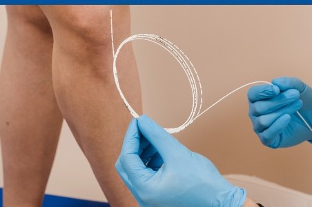 Tromboza venoasa profunda: cauze, tratament, complicatii