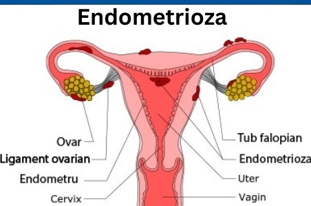 Totul despre Endometrioza – ce este, care sunt simptomele si cum se trateaza?