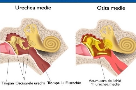 Otita acuta: tipuri, simptome si tratament