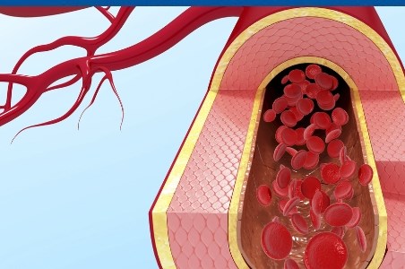 Reducerea riscului de boala arteriala periferica (BAP)